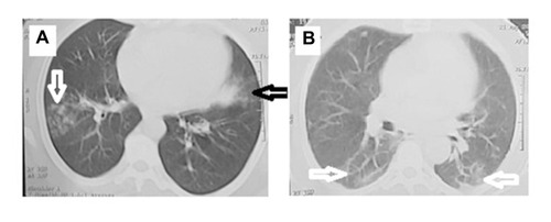 Figure 2 Radiological examination of COVID-19 patient. (A) COVID-19 pneumonia in a 48-year-old female who complained of intermittent fever, shortness of breath and headache for 3 days before admission. Plain computed tomographic scan of the lung shows an area of ground-glass attenuation on one side (black arrow) and tree in bud appearance on the other side(white arrow). (B) COVID-19 pneumonia in a 57-year-old male who complained of, headache, vomiting, diarrhea for 5 days before admission. Plain computed tomographic scan of the lung that shows an area of crazy paving with interlobular septal thickening in both lower lobes (white arrows).