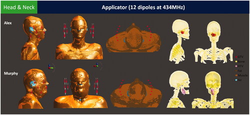 Figure 2. The benchmark H&N applicator consists of twelve half-wavelength dipole antennas distributed over three rings. The benchmark patient models Alex and Murphy include a tumor in the nasopharynx and oropharynx regions (postoperative case), respectively. Only bones and tumors are shown for clarity, please refer to Tables 2 and 3 for the complete list of tissues used in the model.
