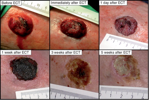 Figure 7. The effect of electrochemotherapy (ECT) with bleomycin on bleeding melanoma metastasis.It can be observed that bleeding of this tumor was stopped immediately after the application of ECT. Gradually a crust was formed in place of the tumor (within 1 week), which fell off 3 weeks after the treatment. This particular tumor reduced in size dramatically and remained in partial response during the 21 weeks observation time.ECT: Electrochemotherapy.Reproduced with permission from Citation[100].