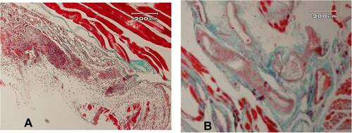 Figure 3 Histology of blood vessels in fibrotic capsule in tissue surrounding implants. (A) Implant treatment group+ PRP group (40×); (B) implant treatment group (40×).