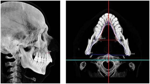 Figure 1. Imaging and measurements obtained by SYM 3D Protocol assessing maxillomandibular sagittal and axial discrepancy to A-B point.