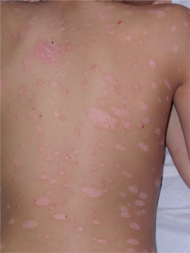 Figure 1 Plaque psoriasis in a 13-year-old boy.
