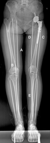 Figure 1 The full-length standing anteroposterior radiograph. (A) TD-TP: distance between the inferior aspect of teardrop (TD) and the midpoint of tibial plafond (TP). (B) CH-TP: distance between the center of hip (CH) or acetabular cup and the midpoint of tibial plafond. (C) GT-TP: distance between the apex of greater trochanter (GT) and the midpoint of tibial plafond. (D) femoral length (FL): distance between the inferior aspect of teardrop and the articular surface of medial femoral condyle. (E) tibial length (TL): distance between the center of the tibial intercondylar eminence and the midpoint of tibial plafond.