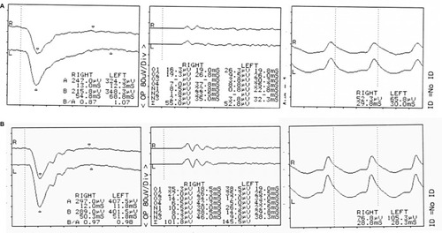 Figure 3 Full-field electroretinograms showing changes before and after pulse steroid therapy.