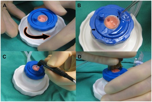 Figure 5 Prior to the second pass, the blue locking ring is loosened so that the guide ring can be rotated (A). The reference mark (thick arrow) is now turned 180 degrees away from the initial alignment mark (thin arrow) (B). Central pachymetry is remeasured (C) prior to the second pass (D).