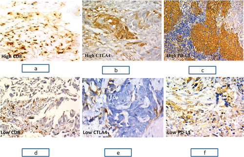 Figure 1. Immunohistochemical staining for immune markers in NSCLC. (a) A case of moderately differentiated squamous cell carcinoma showing tumor infiltrating lymphocytes with strong brown membranous staining for CD8 with total score 12.(X200). (b) A case of acinar adenocarcinoma showing strong brown cytoplasmic staining for CTLA 4 with total score 2B.(X400). (c) A case of poorly differentiated squamous cell carcinoma showing strong brown membranous staining for PD-L1 with total score 2. (X200). (d) A case of acinar adenocarcinoma showing tumor infiltrating lymphocytes with moderate brown membranous staining for CD8 with total score 4.(X200). (e) A case of moderately differentiated squamous cell carcinoma showing moderate brown cytoplasmic staining for CTLA4 with total score 1b. (X400). (d) A case of solid adenocarcinoma showing moderate brown membranous staining for PD-L1 with total score 1. (X400)