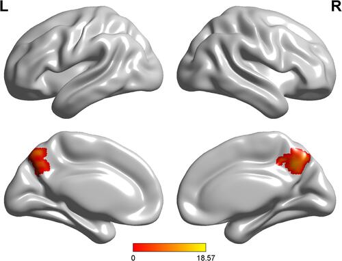 Figure 2 One-way ANOVA of DMN functional connectivity. Thresholds were set at a corrected P < 0.01, determined by Monte Carlo simulation.