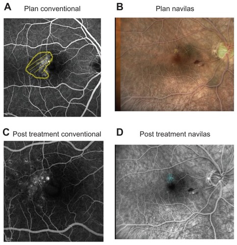 Figure 1 Examples before and after laser. Two sample patients conventionally treated (patient A) or treated by Navilas® (patient B). (A) Fluorescein angiography with treatment area marked. (B) Navilas fundus photograph with fluorescein angiography overlay and preplanned laser spots. (C) Three-month follow-up on fluorescein angiography. (D) Fluorescein angiogram with executed laser treatment spots marked by Navilas.