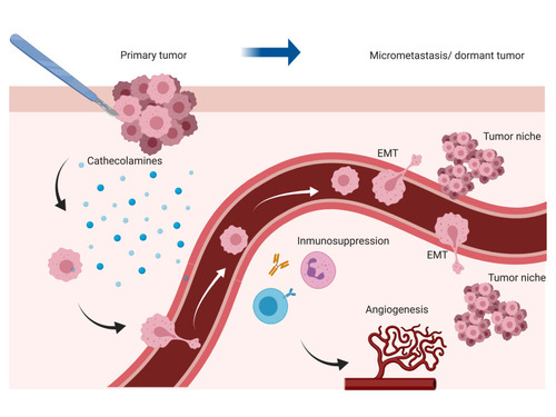 Figure 1 Perioperative events that influence tumor metastasis and cancer recurrence. Surgery for tumor resection triggers the release of catecholamines, immunosuppression, and angiogenesis. It has been speculated that these factors facilitate epithelial-mesenchymal transition (EMT) and promote a conducive microenvironment (tumor niche) for cells to migrate, invade and proliferate.
