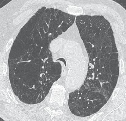 Figure 5 Tracheomalacia elicited by coughing maneuver in 65-year-old man. CT scan shows near complete collapse of airway lumen, consistent with tracheomalacia. Advanced centrilobular and paraseptal emphysema also coexist.