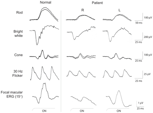 Figure 6 Full field ERGs (rod, bright white, cone and 30 Hz flicker) and focal macular ERG recorded one month after chemotherapy. The ERG amplitudes of all components have increased after therapy but still remained smaller than normal ERGS in both eyes.