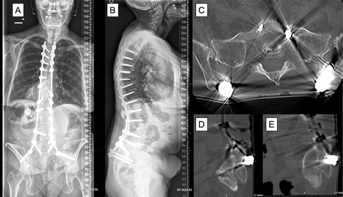 Figure 3 (A and B) Patient who underwent a T5-ilium PSIF in 2013 with solid fusion. Nine years later she experienced prominence of her iliac instrumentation and skin breakdown. (C) Axial CT scan shows iliac screws close to the skin, with sagittal CT scans of the (D) right and (E) left screws eroding through the skin. The rods were cut proximal the screw, the screws were removed, and plastic surgery rotated paraspinal muscle flaps for closure. Of note, the unilateral left L3 rod fracture was asymptomatic.