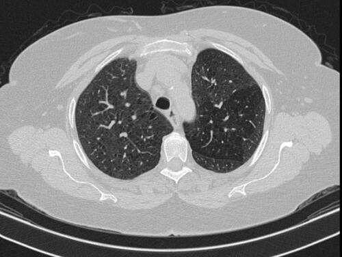 Figure 3 HRCT of chest showing ground glass opacities.
