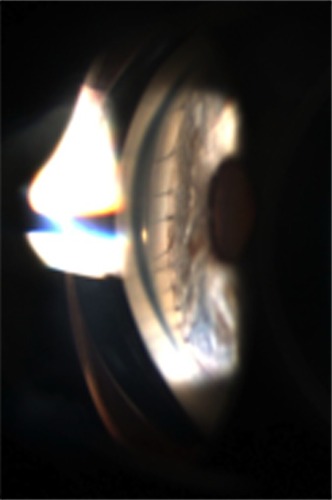 Figure 2 Gonioscopic view of the cyclodialysis cleft after repair.