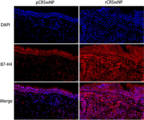 Figure 5 Immunofluorescence and B7-H4 protein expression in primary and recurrent CRSwNP patients. Representative immunofluorescence images of pCRSwNP and rCRSwNP patients (magnification, x400).