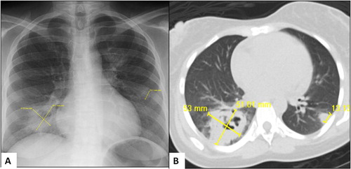 Fig. 2 Chest radiography (A) showing pleural-based nodules which are better visualized on computed tomography with cavity in the right lower lobe (B).