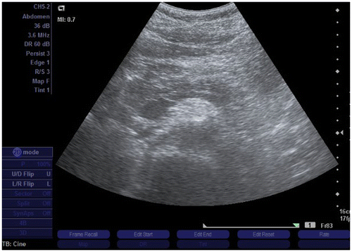 Figure 1a. Abdominal ultrasound: ultrasound image showing slight enlargement of the pancreatic head.