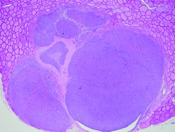 Figure 4. Histopathology of the parathyroid gland. The gland is markedly expanded by multifocal hyperplastic nodules with no atypical cells.