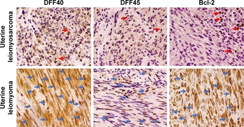 Figure 1 Weak DFF40, DFF45, and Bcl-2 expression (400×) in uterine leiomyosarcomas (red arrows) compared to strong DFF40, Bcl-2, and moderate DFF45 expression in uterine leiomyomas (blue arrows).