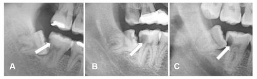 Figure 1 Distal adjacent caries of MSM (white arrow). (A) Mild caries. (B) Moderate caries. (C) Severe caries.