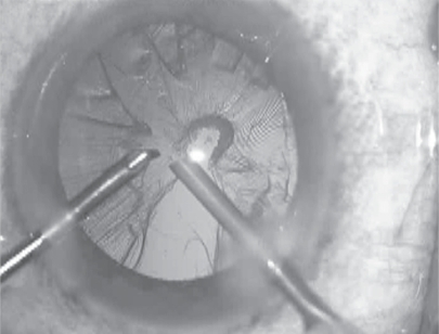 Figure 2 Nucleus removal completed.