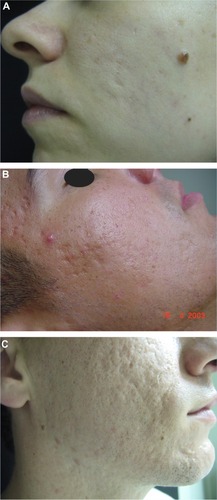 Figure 1 Acne scars.