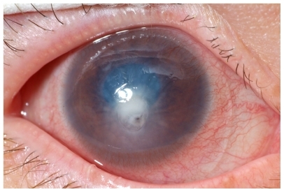 Figure 1 Perforation of corneal ulcer.