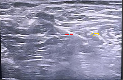Figure 3 Ultrasound view of Suprascapular nerve block. (Needle (red arrow), Suprascapular Nerve (yellow arrow).