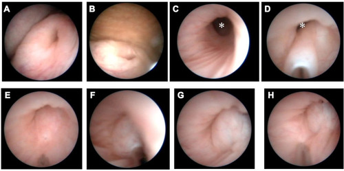 Figure 2 The first half of SMHIT (systematic-multisite hydrodistention implantation technique) for left VUR grade Ⅳ. ＊Extravesical portion of ureter (adjacent to ureteral hiatus). (A) Left ureteral orifice before SMHIT. (B) Mild opening of the ureteral orifice during hydrodistention. (C) intramural ureter. (D) First insertion of a needle and injection of Dx/HA. (E) Bulge after first injection of Dx/HA and second insertion of a needle. (F) Second injection of Dx/HA. (G) Bulge after second injection of Dx/HA. (H) Bulge after second injection of Dx/HA and third insertion of a needle.