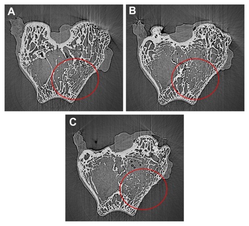 Figure 9 SR m-CT of cross-section images of n-CDAP–PCL–PEG–PCL composite scaffolds implanted into bone defects of rabbit femora for (A) 1, (B) 2, and (C) 3 months.Abbreviation: n-CDAP-PCL–PEG–PCL, nano calcium-deficient apatite and poly (ɛ-caprolactone)–poly(ethyleneglycol)–poly(ɛ-caprolactone).