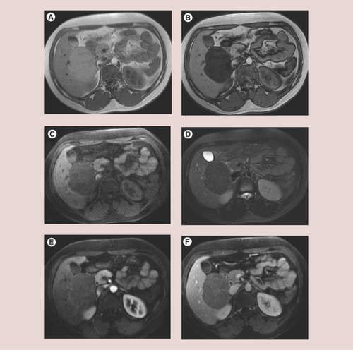 Figure 2. Imaging features of HNF1A inactivated hepatocellular adenoma.Large HNF1A-inactivated hepatocellular adenoma (HCA) in a 26-year-old woman. In chemical shift T1-weighted sequence, HCA has moderate hyperintensity in-phase (A), with a marked signal dropout on opposed-phase images (B). The lesion is hypointense in both T1 (C) and T2 (D) fat-suppressed sequences due to the lipid content. After contrast medium injection, there is only slight arterial enhancement (E), but the lesion remains hypointense compared with the normal liver on portal venous phase (F).