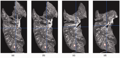 Figure 4. CT image sequence corresponding to the progressive loading applied to the deflated lung. The tumor slice in each image is outlined by a red circle. The same tumor slice has been tracked and shown throughout the CT image sequence.