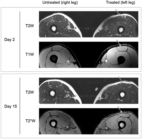 Figure 3. MR images of untreated and treated muscles. Representative MR images of the untreated and treated muscle (patient no. 2) acquired Day 2 and Day 15 after treatment. Different MR sequences were used: T2-weighted (T2W) sequence to assess edema; T1-weighted (T1W) gradient-echo (GRE) isotropic sequence to detect acute bleeding and a T2*-weighted (T2*W) sequence to detect coagulated blood i.e. detection of remnants of previous bleeding. Minimal intramuscular edema and discrete intramuscular bleeding in the area corresponding to the insertion of the needle electrode is seen at Day 2. The changes are no longer present at Day 15.