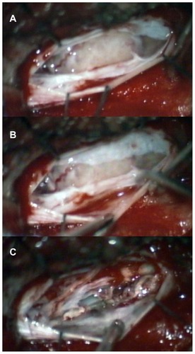 Figure 3 Intraoperative images. (A and B) Intraoperative evidence of two dural layers with the spinal meningioma attachment to the inner layer. (C) Final view demonstrating the preserved outer dural layer as well as complete removal of the lesion together with the inner dural layer.