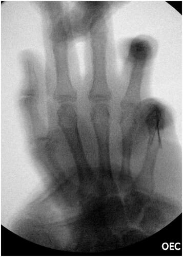 Figure 3. X-ray of the right-hand showing K-wire fixation.