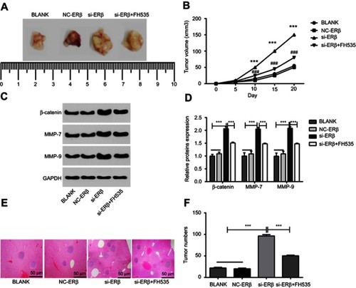 Figure 6 The growth and metastasis of OS tumors in mice. (A) Subcutaneous tumors under naked eye; (B) subcutaneous tumor volumes at different time points; (C) protein brands of Western blot; (D) relative expression of β-catenin, MMP-7 and MMP-9 at protein level (Western blot); (E) metastatic tumors in the liver tissues of mice under microscope (HE staining) (bar =50 μm, ×40); (F) the number of metastatic tumors. si-ERβ, U2-OS cells transfected with siRNA-ERβ for 48 hrs; NC-ERβ, U2-OS cells transfected with siRNA-negative control-ERβ for 48 hrs; si-ERβ + FH535, U2-OS cells transfected with siRNA-ERβ and treated with 20 μmol/L FH535 for 48 hrs; blank, U2-OS cells without transfection and treatment. ***P<0.001 vs NC-ERβ and blank; ###P<0.001 vs si-ERβ.Abbreviations: ERβ, estrogen receptor β; OS, ostemsarcoma; GAPDH, glyceraldehyde-3-phosphate dehydrogenase; MMP, matrix metalloproteinase; HE, hematoxylin-eosin; NC, negative control; si, small interfering RNA.