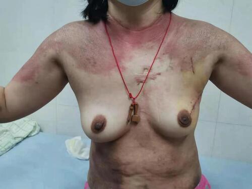 Figure 5 1 week after breast cancer surgery.