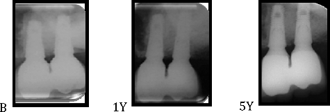 Figure 3. Periapical results of the left side of the patient (DBBM/CM side) at baseline (B), 1 and 5 years.