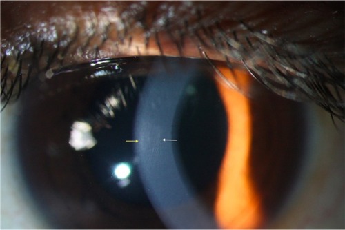 Figure 4 Slit-lamp photograph of the same eye as in Figure 3, showing apical scarring (yellow arrow) and Vogt’s striae (white arrow).