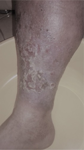 Figure 1 Local status of patient’s shin before the beginning of physical treatment.