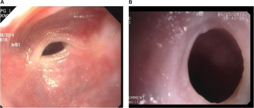 Figure 4 Endoscopic view of upper esophagus showing webs: (A) semilunar or crescent, and (B) circumferential.
