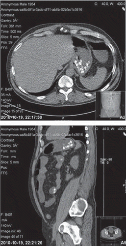 Fig. 1. A computed tomography of the abdomen performed about 2 hours after a large lithium sulphate overdose and showing numerous tablets in the stomach and small intestine.