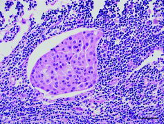 Figure 2. Lymph node metastasis from a mammary carcinoma in a Sika deer seen as a cluster of large polygonal carcinoma cells within a lymphatic vessel in the subcapsular sinus of the mediastinal lymph node; haematoxylin & eosin. Bar = 50 μm.