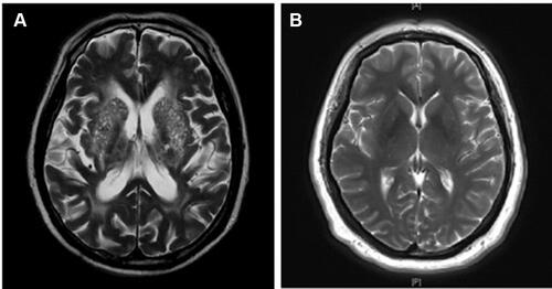 Figure 2 MRI of BG-EPVS and control groups. Patients with >20 BG-EPVSs on the unilateral side of the basal ganglia slice containing the most EPVSs were defined as the BG-EPVS group (A) and the rest as controls (B).