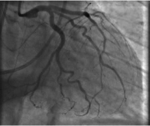 Figure 2. Coronary artery angiography showing the normal flow.