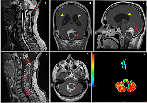 Figure 1 Brain MRI features: post contrast coronal (B), sagittal (C), and axial (E), T1-weighted sequences. See the obstructive hydrocephalus showing abnormally large lateral ventricles (yellow arrows on (B and C)), and the intra-axial mass located on cerebellar vermis with its solid and cystic components (red arrows on (A, B, C and E)). Cerebellar detail on axial apparent diffusion coefficient (ADC) map (F). Cervical spine MRI features: post contrast, sagittal T2 weighted sequences (A), and sagittal T1 weighted sequences (D). See the cerebellar mass and the multifocal spinal cord with leptomeningeal seeding (red arrows on (A and D)).