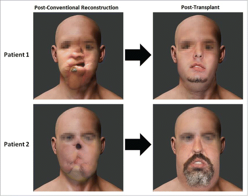 Figure 1. SIGSWs patients following partial face transplantation.