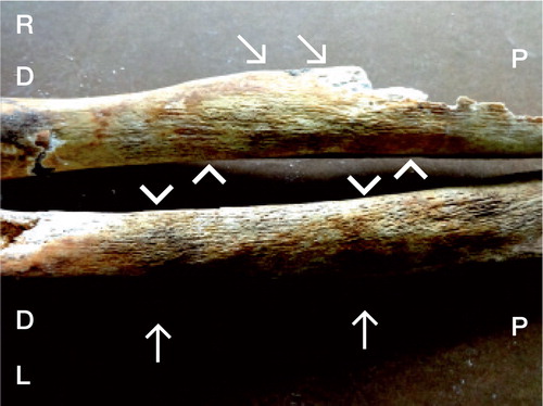Figure 2. Right (R) and left (L) tibiae with lesions distributed over the posterior-medial diaphyseal aspects. The right tibia shows less well developed cortical lesions and differentiated outline consequent to a striking increase in cortical bone. For legends, see Figure 1.