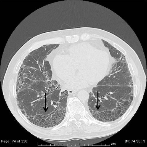 Figure 1 High-resolution computed tomography image demonstrating usual interstitial pneumonia pattern, with bilateral, basal, and subpleural predominant reticular abnormality and honeycombing (arrows).