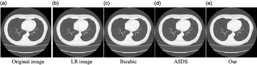 Figure 8. Comparison of the reconstructed images of various methods for noisy medical image (Equation3(3) α=argminα∥α∥1,s.t.∥x−Φα∥2≤ε(3) ).